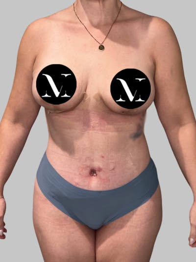 Tummy Tuck Before & After Gallery - Patient 426494 - Image 2