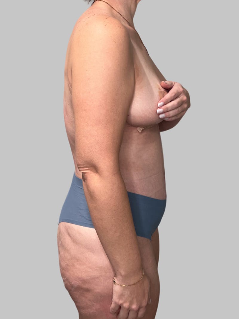 Tummy Tuck Before & After Gallery - Patient 426494 - Image 6