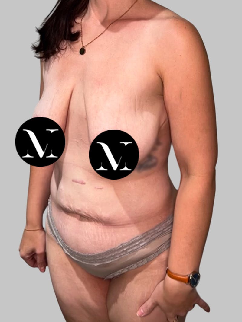 Tummy Tuck Before & After Gallery - Patient 426494 - Image 7