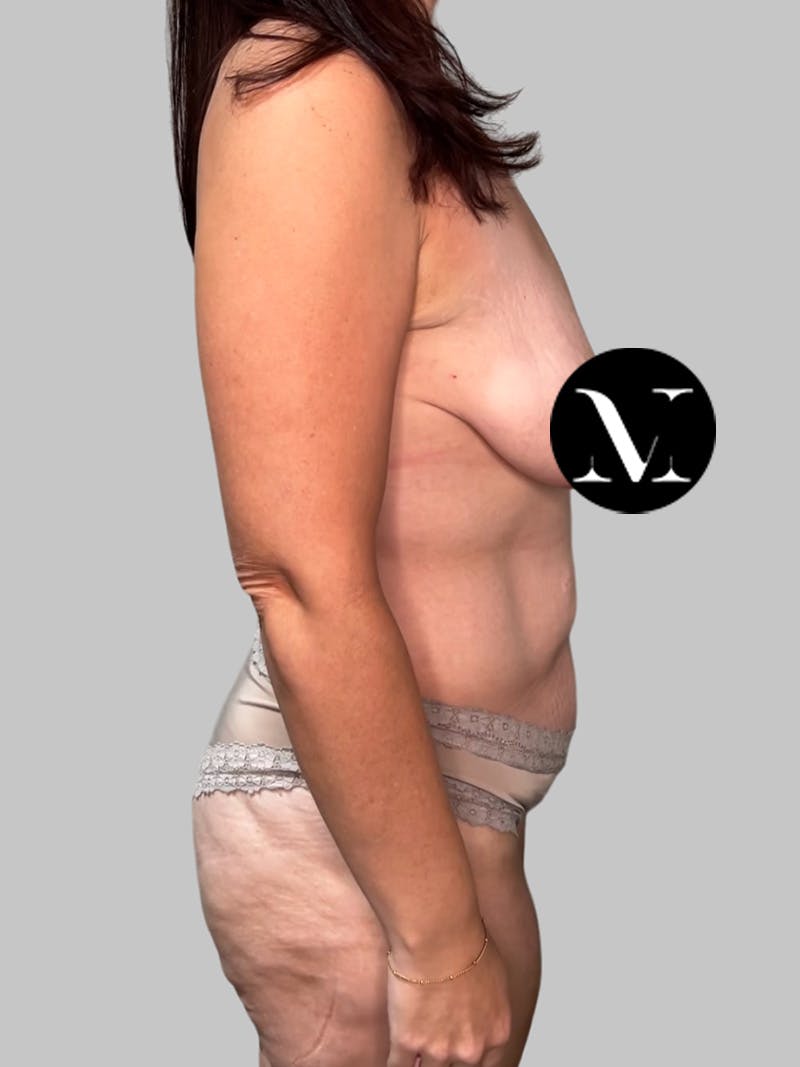 Tummy Tuck Before & After Gallery - Patient 426494 - Image 5
