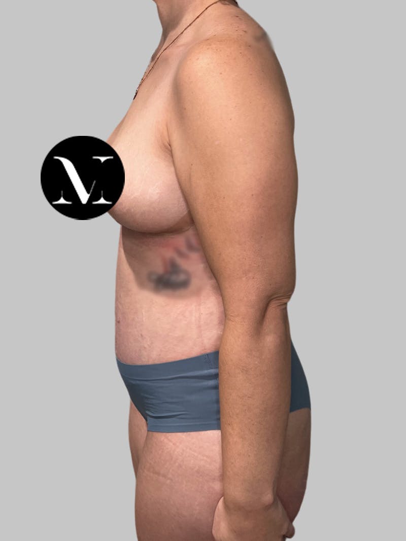 Tummy Tuck Before & After Gallery - Patient 426494 - Image 10