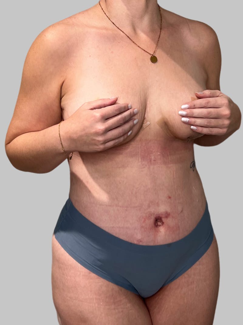 Tummy Tuck Before & After Gallery - Patient 426494 - Image 4