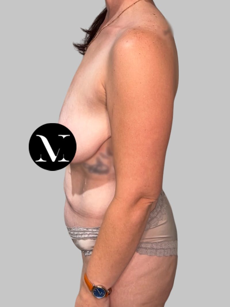 Tummy Tuck Before & After Gallery - Patient 426494 - Image 9