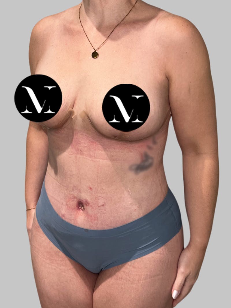 Tummy Tuck Before & After Gallery - Patient 426494 - Image 8