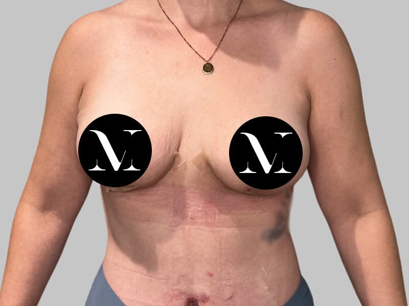 Breast Augmentation Before & After Gallery - Patient 308187 - Image 2