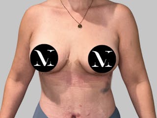 Breast Augmentation Before & After Gallery - Patient 308187 - Image 2