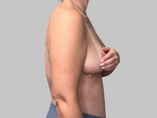 Breast Augmentation Before & After Gallery - Patient 308187 - Image 6