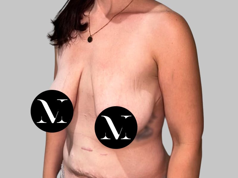 Breast Augmentation Before & After Gallery - Patient 308187 - Image 7