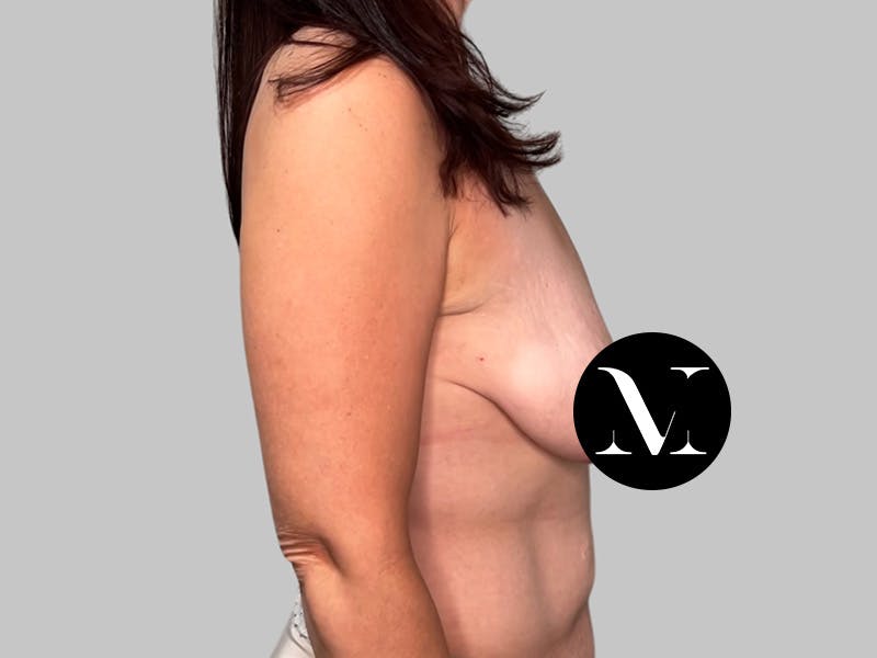 Breast Augmentation Before & After Gallery - Patient 308187 - Image 5