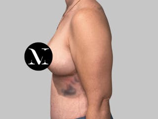 Breast Augmentation Before & After Gallery - Patient 308187 - Image 10