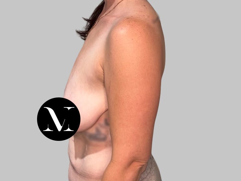 Breast Augmentation Before & After Gallery - Patient 308187 - Image 9