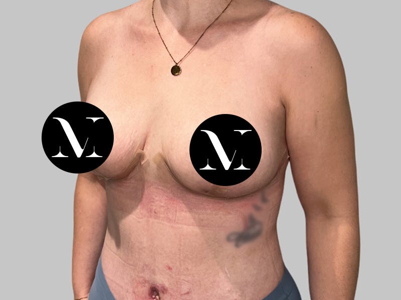 Breast Augmentation Before & After Gallery - Patient 308187 - Image 8