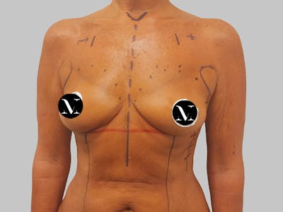 Breast Augmentation Before & After Gallery - Patient 389611 - Image 1