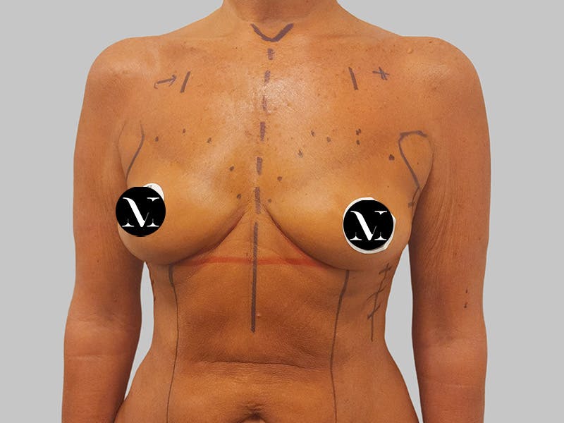 Breast Augmentation Before & After Gallery - Patient 389611 - Image 1