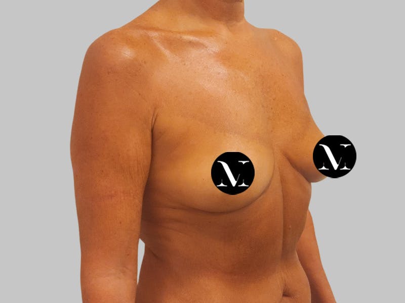 Breast Augmentation Before & After Gallery - Patient 389611 - Image 3