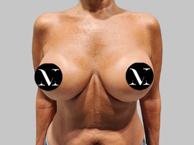 Breast Augmentation Before & After Gallery - Patient 389611 - Image 2
