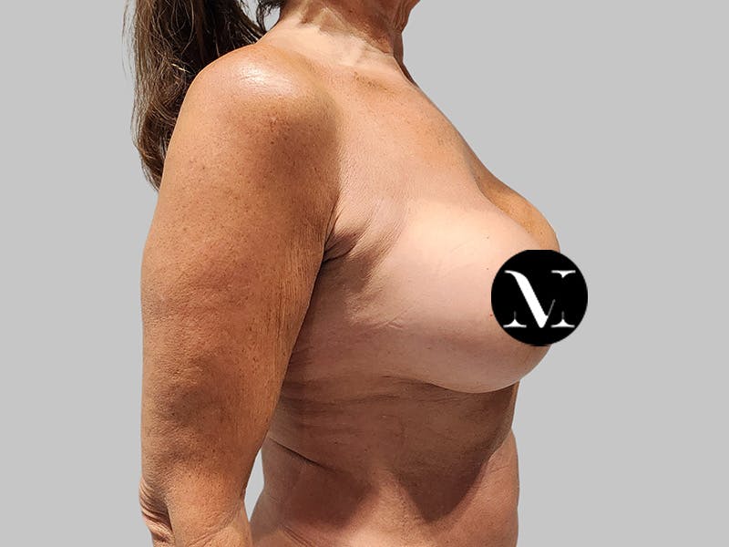 Breast Augmentation Before & After Gallery - Patient 389611 - Image 6
