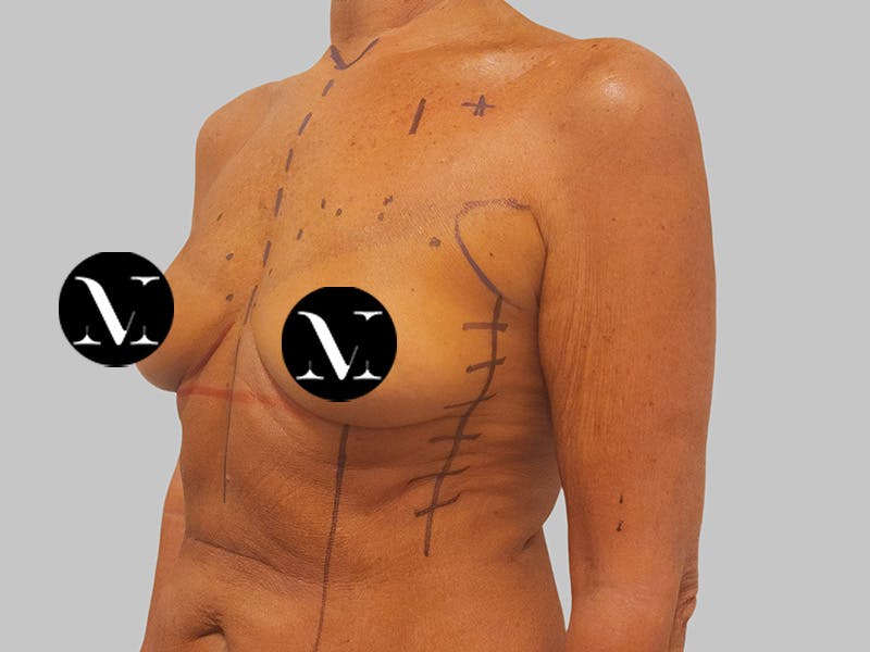 Breast Augmentation Before & After Gallery - Patient 389611 - Image 7
