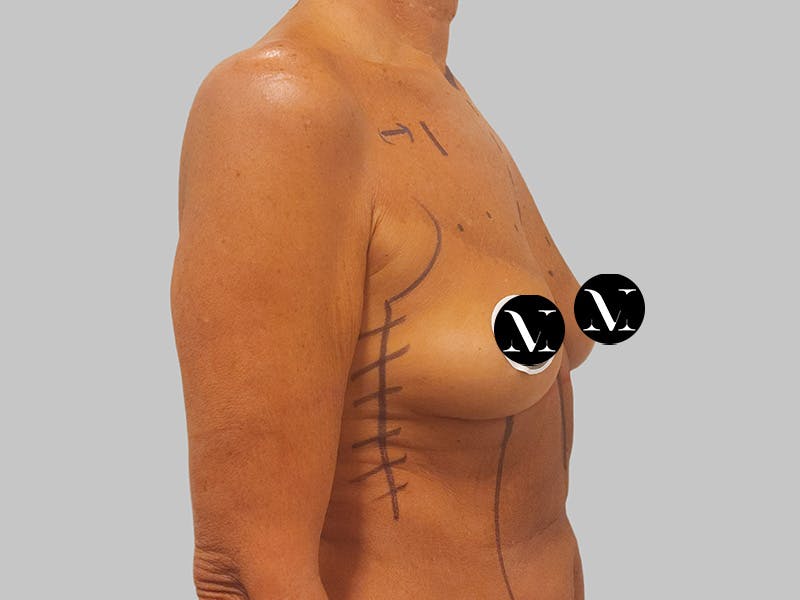 Breast Augmentation Before & After Gallery - Patient 389611 - Image 5