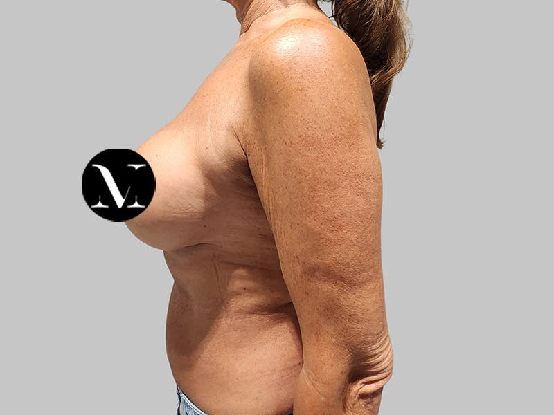 Breast Augmentation Before & After Gallery - Patient 389611 - Image 10
