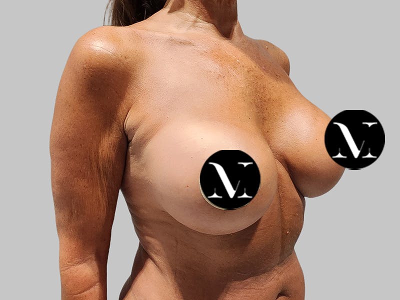 Breast Augmentation Before & After Gallery - Patient 389611 - Image 4