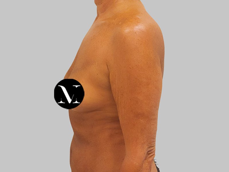 Breast Augmentation Before & After Gallery - Patient 389611 - Image 9