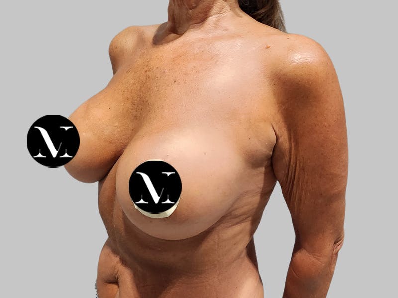Breast Augmentation Before & After Gallery - Patient 389611 - Image 8