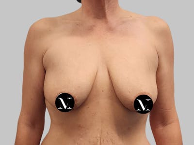 Breast Augmentation Before & After Gallery - Patient 736334 - Image 1