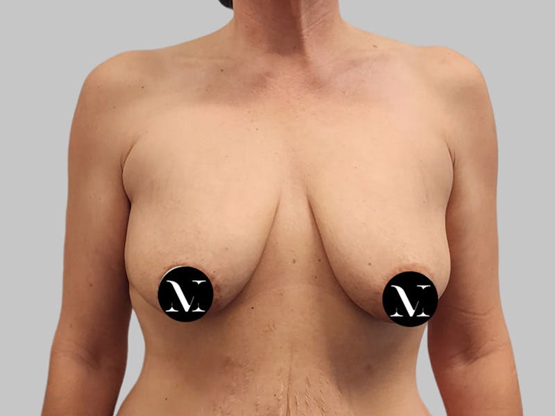 Breast Augmentation Before & After Gallery - Patient 736334 - Image 1