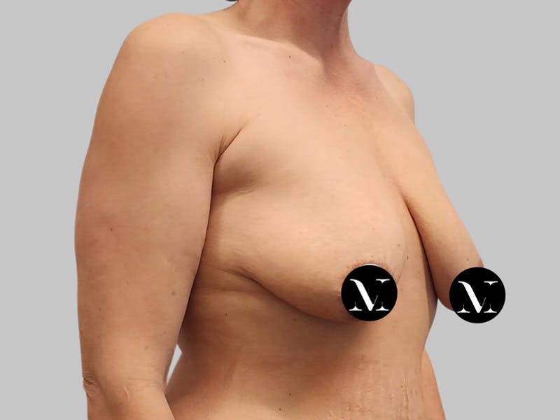 Breast Augmentation Before & After Gallery - Patient 736334 - Image 3