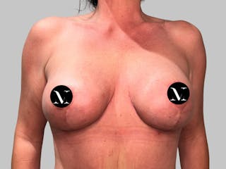 Breast Augmentation Before & After Gallery - Patient 736334 - Image 2