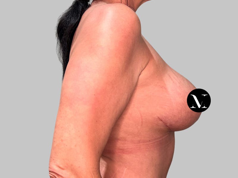 Breast Augmentation Before & After Gallery - Patient 736334 - Image 6