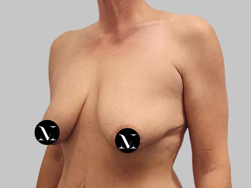 Breast Augmentation Before & After Gallery - Patient 736334 - Image 7