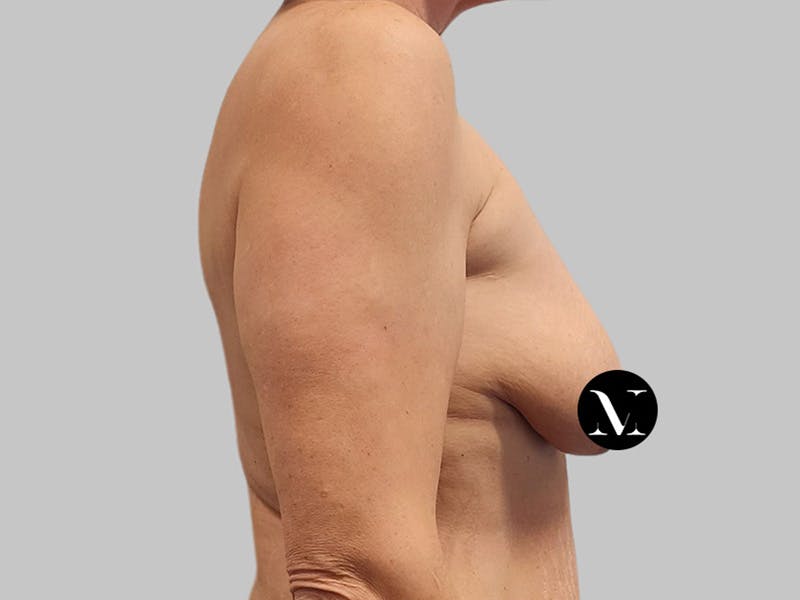 Breast Augmentation Before & After Gallery - Patient 736334 - Image 5