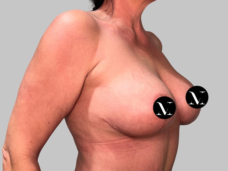 Breast Augmentation Before & After Gallery - Patient 736334 - Image 4