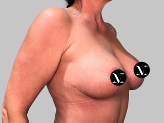 Breast Augmentation Before & After Gallery - Patient 736334 - Image 4