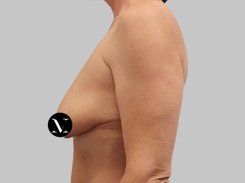 Breast Augmentation Before & After Gallery - Patient 736334 - Image 9