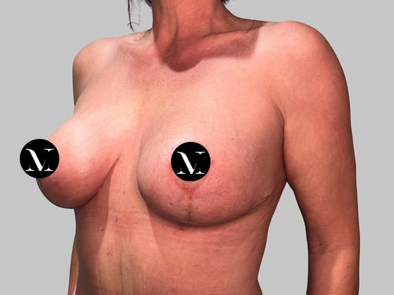 Breast Augmentation Before & After Gallery - Patient 736334 - Image 8