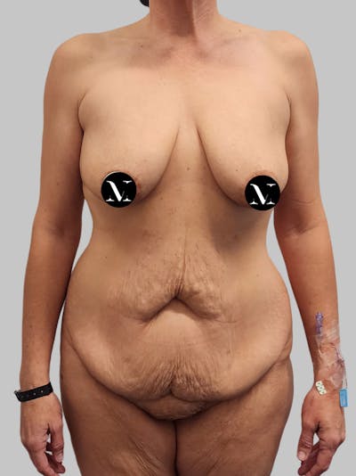 Tummy Tuck Before & After Gallery - Patient 545999 - Image 1