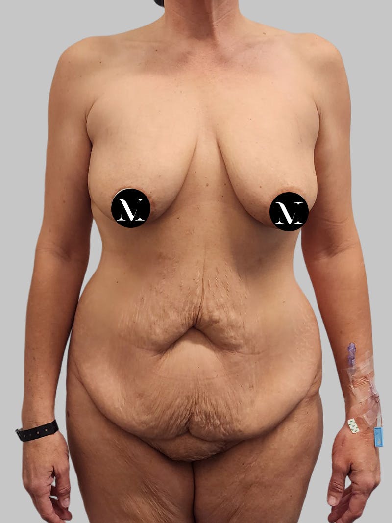 Tummy Tuck Before & After Gallery - Patient 545999 - Image 1