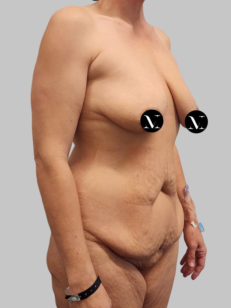 Tummy Tuck Before & After Gallery - Patient 545999 - Image 3