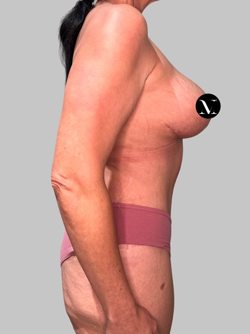 Tummy Tuck Before & After Gallery - Patient 545999 - Image 6