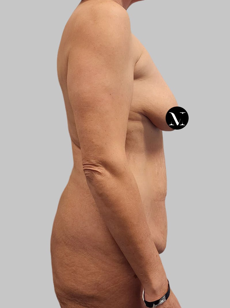 Tummy Tuck Before & After Gallery - Patient 545999 - Image 5