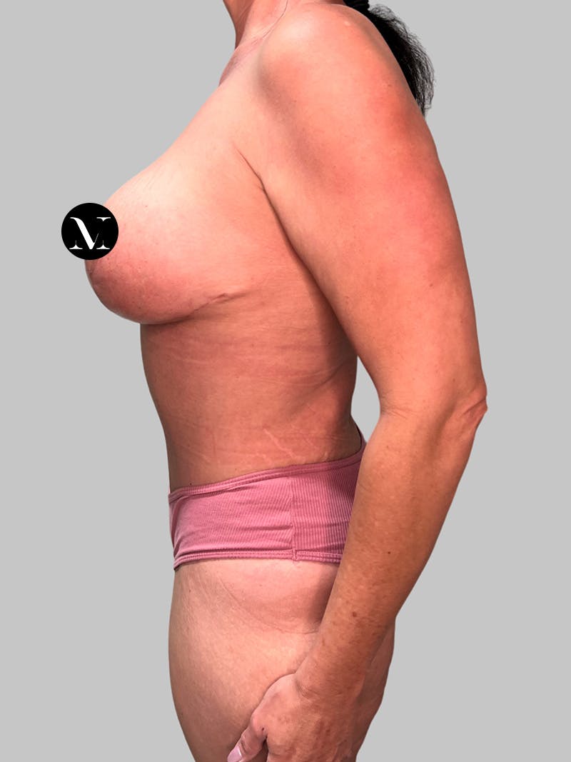 Tummy Tuck Before & After Gallery - Patient 545999 - Image 10