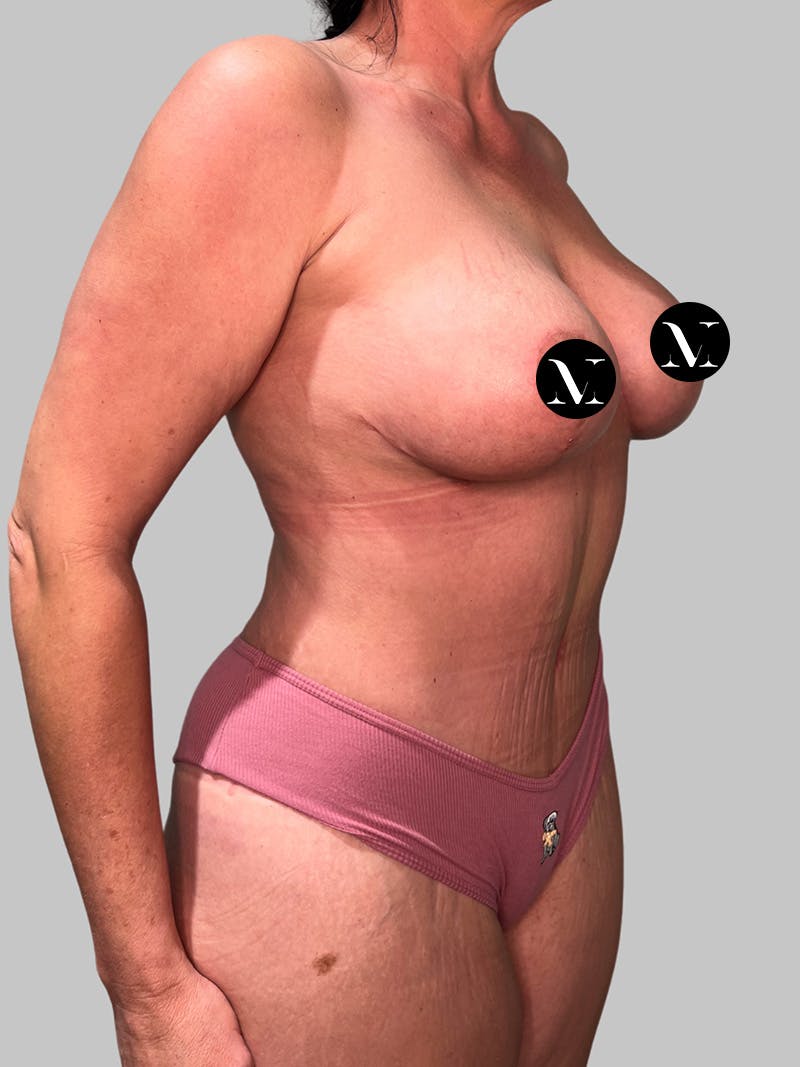 Tummy Tuck Before & After Gallery - Patient 545999 - Image 4