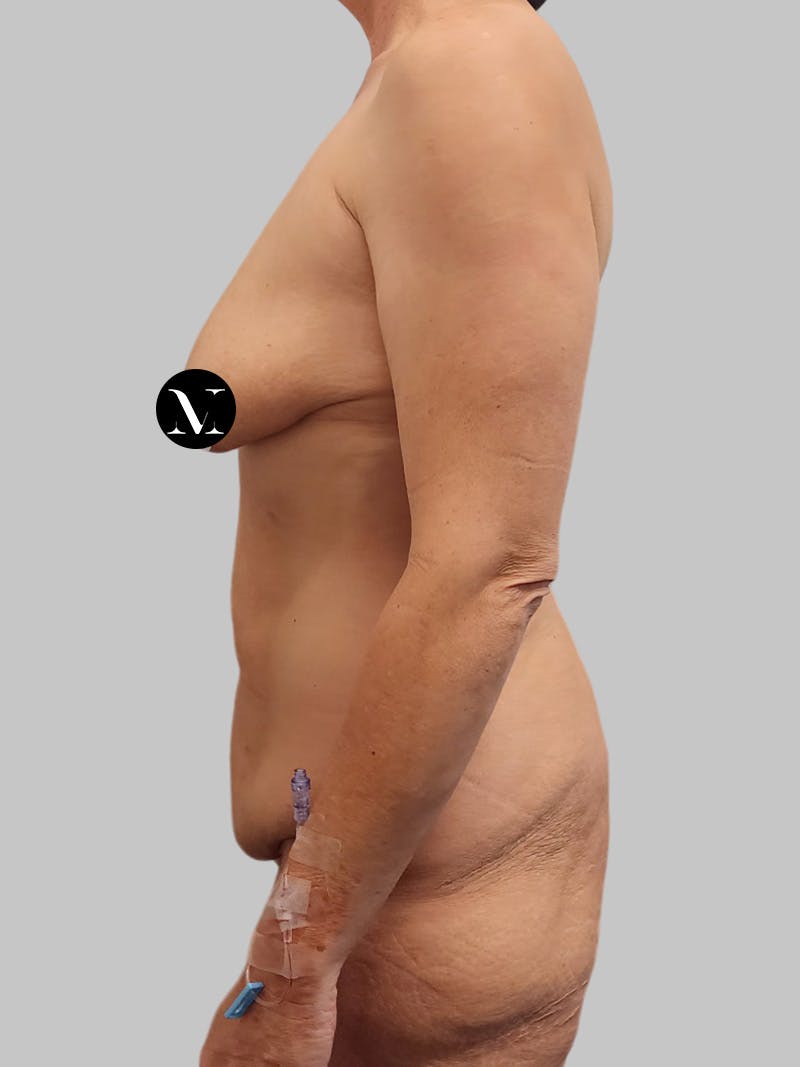 Tummy Tuck Before & After Gallery - Patient 545999 - Image 9