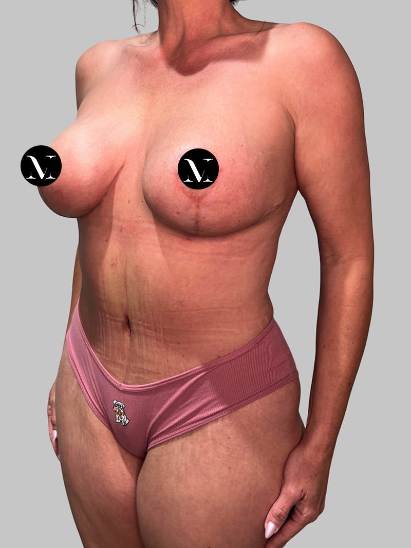 Tummy Tuck Before & After Gallery - Patient 545999 - Image 8