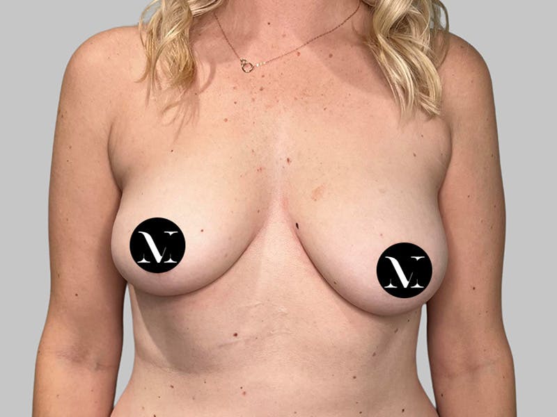 Breast Augmentation Before & After Gallery - Patient 115333 - Image 1