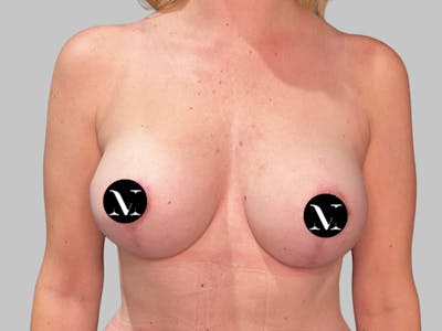 Breast Augmentation Before & After Gallery - Patient 115333 - Image 2