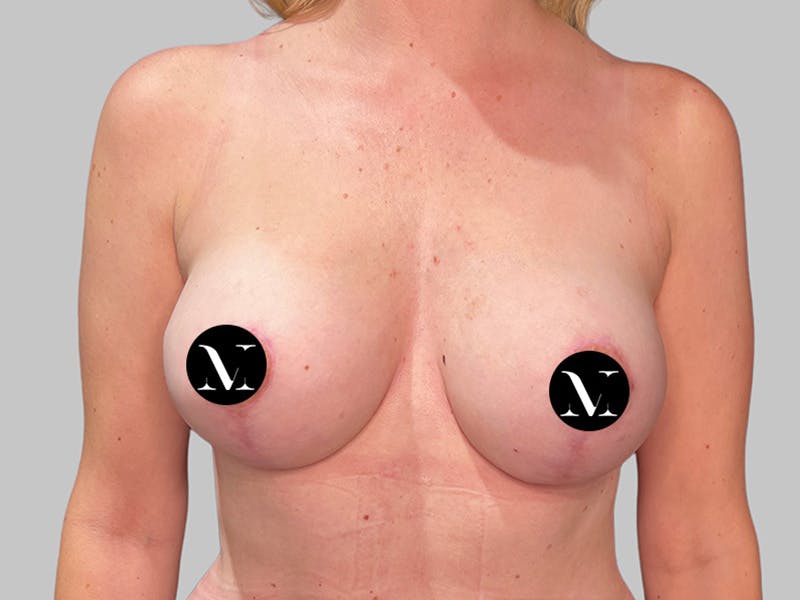 Breast Augmentation Before & After Gallery - Patient 115333 - Image 2